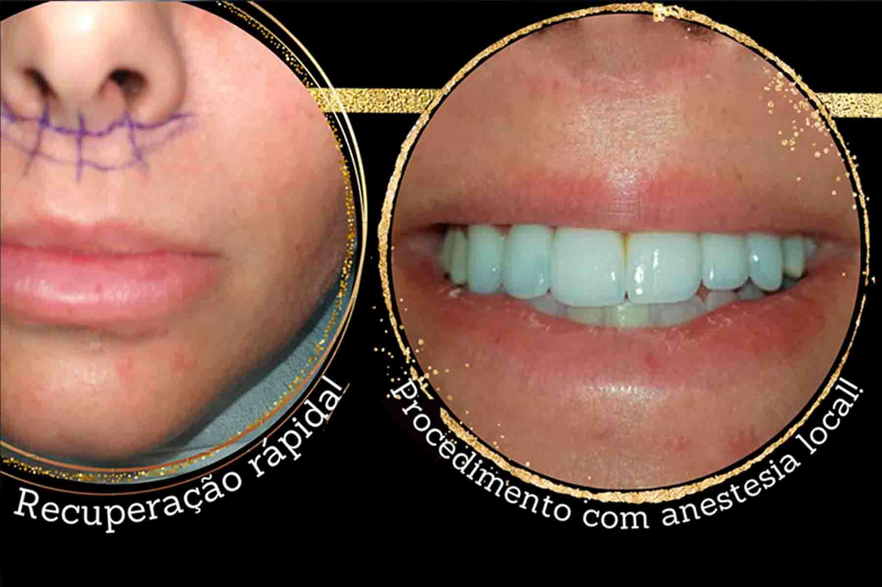 LIP LIFT