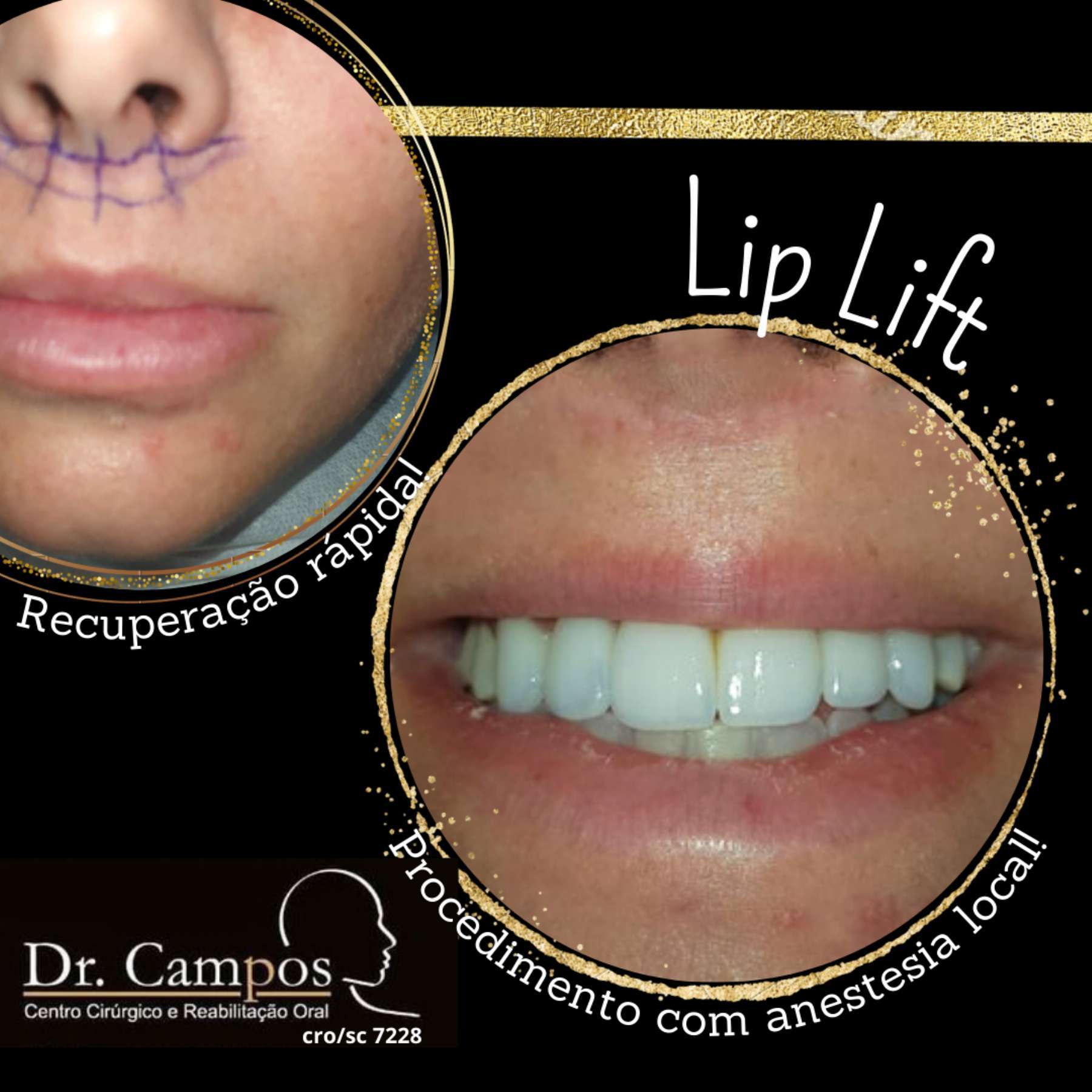 LIP LIFT