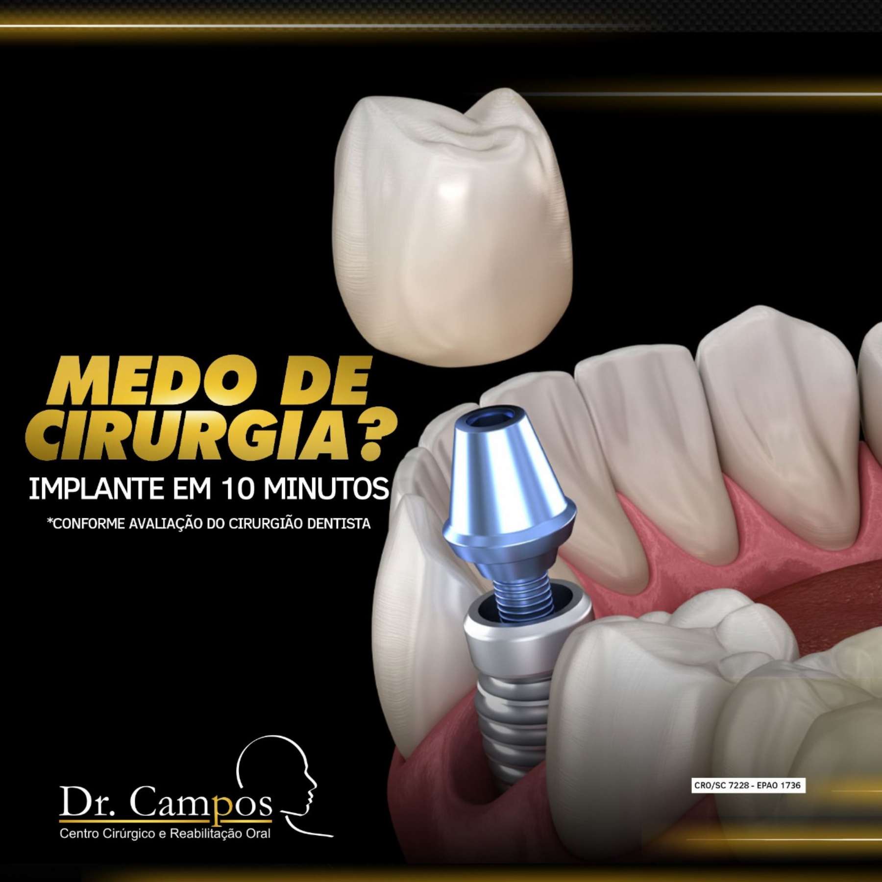 Medo de cirurgia?  Implante em 10 minutos.