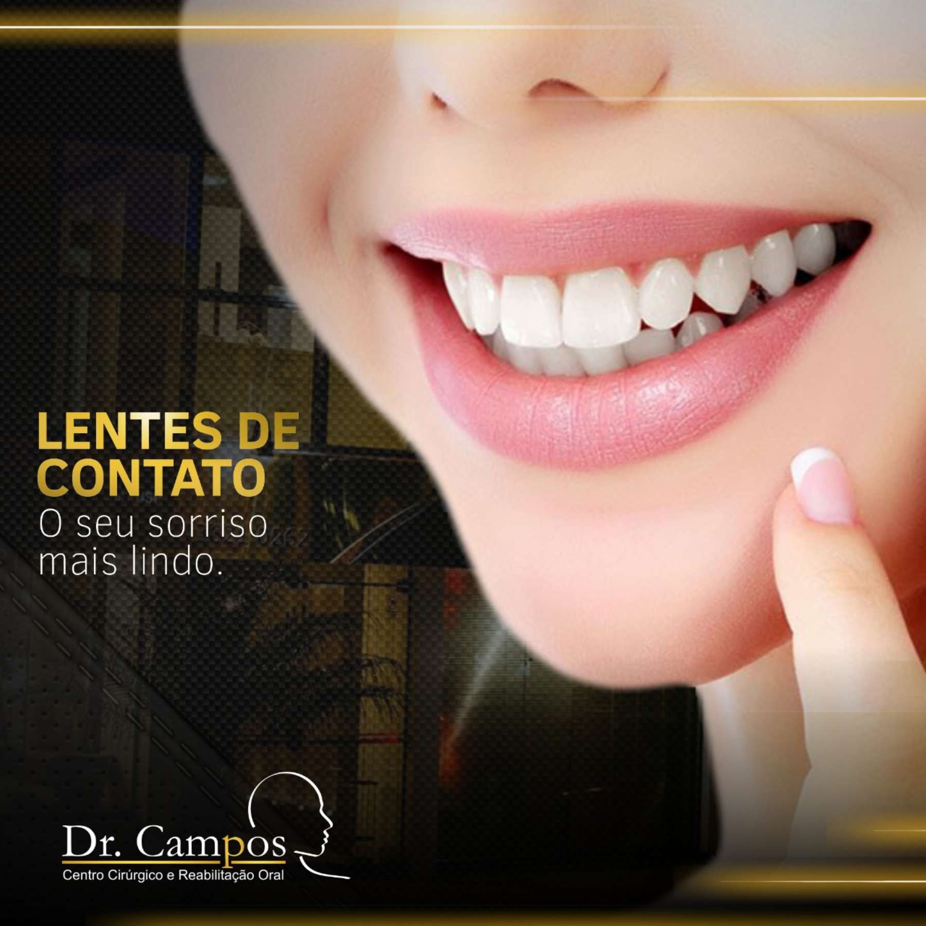 Lente de Contato Dental