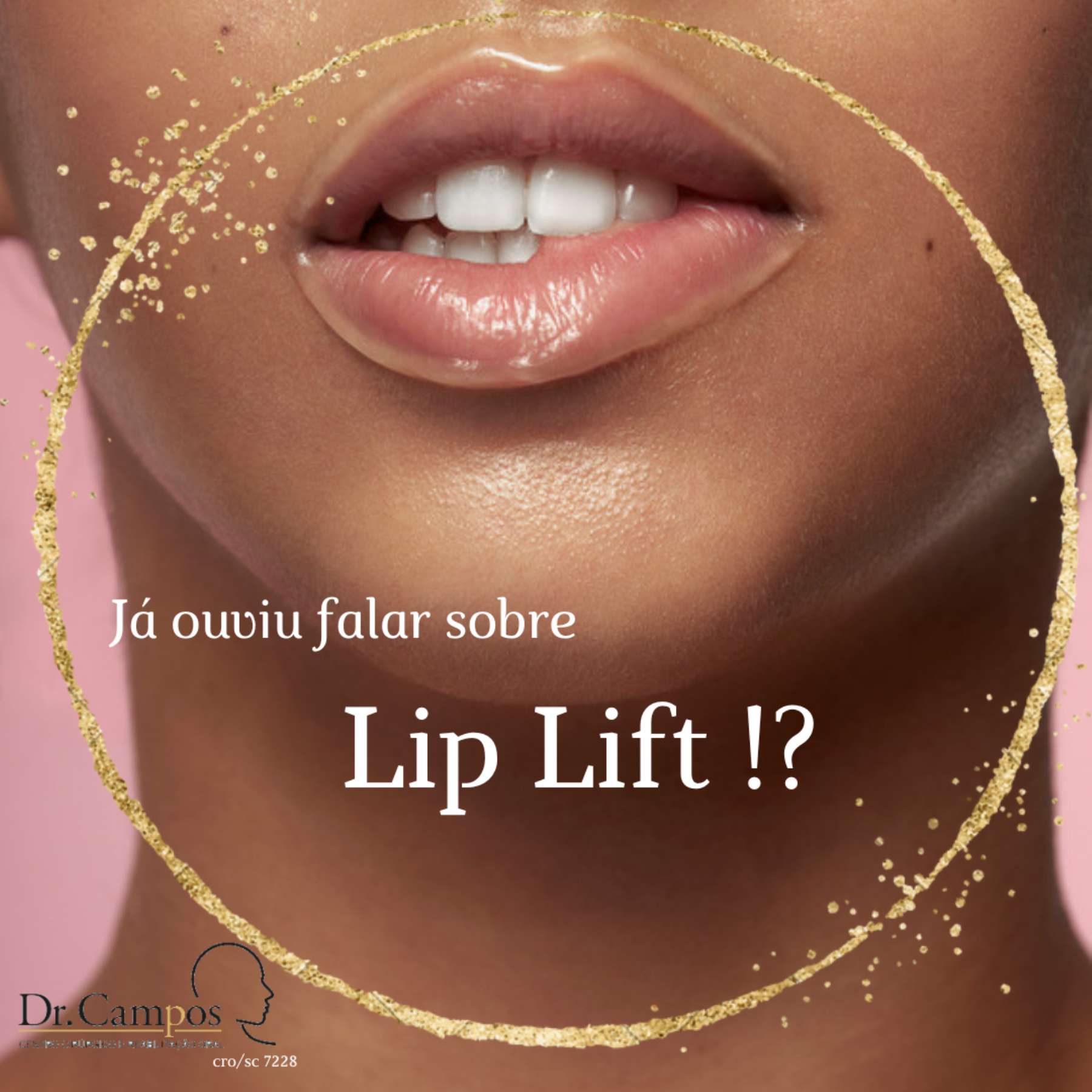 LIP LIFT